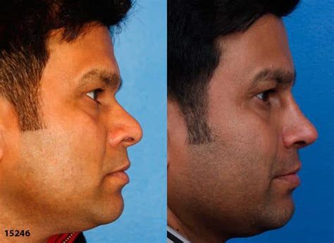 Ethnic Rhinoplasty In New York City Dr Philip Miller