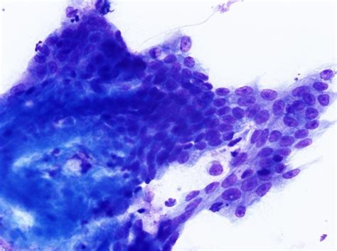 Cytologic Diagnosis Of Canine Gastrointestinal Neoplasia Via Ultrasound