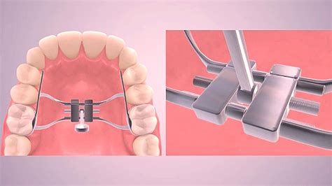 Rapid Palatal Expander Youtube