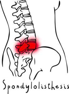 Spondylolisthésis Des exercices efficaces d ostéopathe