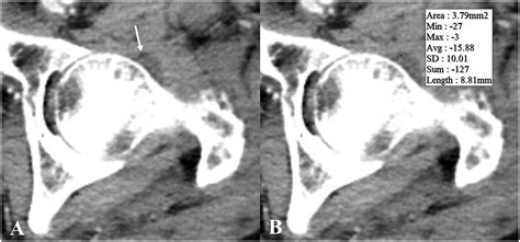 J Bone Joint Surg On Twitter Prevention Of Unplanned Surgery Due To