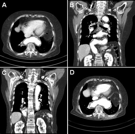 Southwest Journal of Pulmonary, Critical Care and Sleep - Imaging - Medical Image of the Week ...