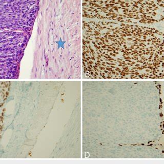 Histologic Evaluation And Staining Of Myoepithelial Carcinoma A