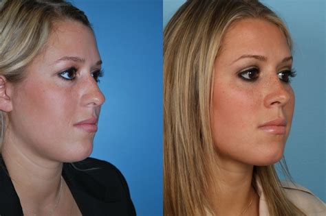 Rhinoplasty Chicago Il Nose Job Surgery Dr Sidle