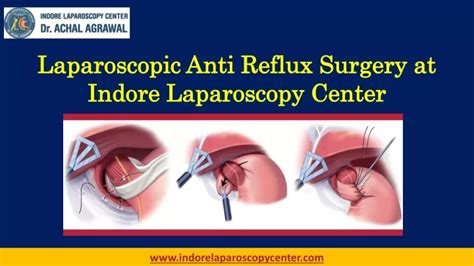 Ppt Laparoscopic Anti Reflux Surgery At Indore Laparoscopy Center