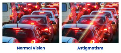 Astigmatism EN Total Canada