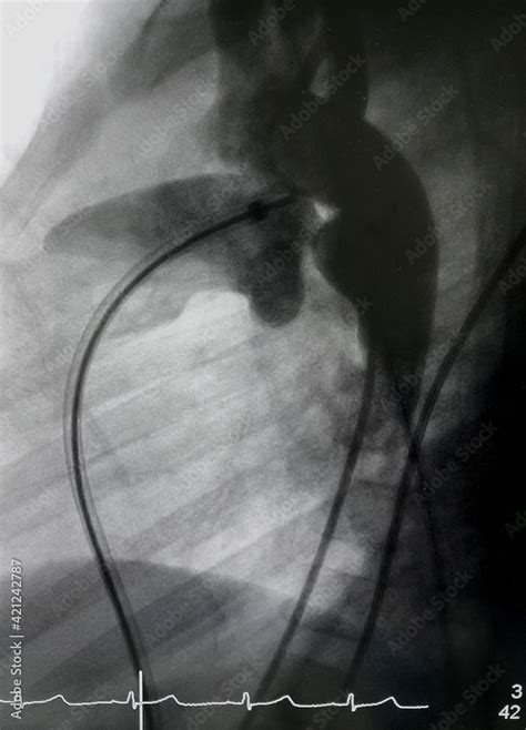 Aortography showed patent ductus arteriosus (PDA) during PDA closure device via endovascular ...