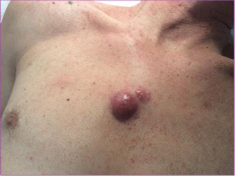 Figure 1 From Recurrence Of Primary Cutaneous Anaplastic Large Cell Lymphoma At A New Location