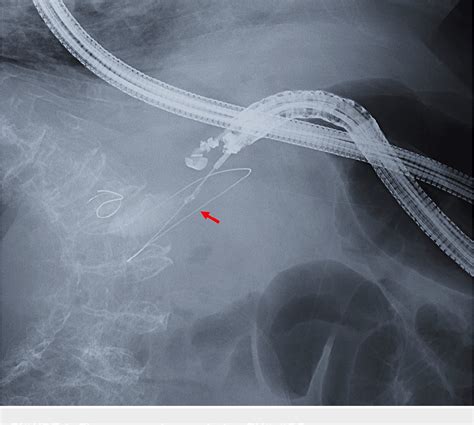 Figure 3 From A Case Of Acute Cholecystitis Successfully Treated With