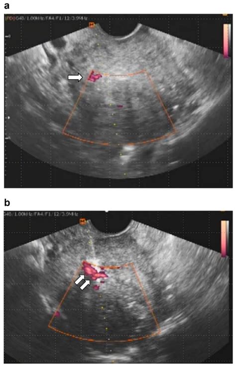 Myoma With Hypermenorrhea Treated With Ultrasound Guided Microwave