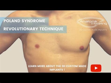 Anatomikmodeling Poland Syndrome En Youtube