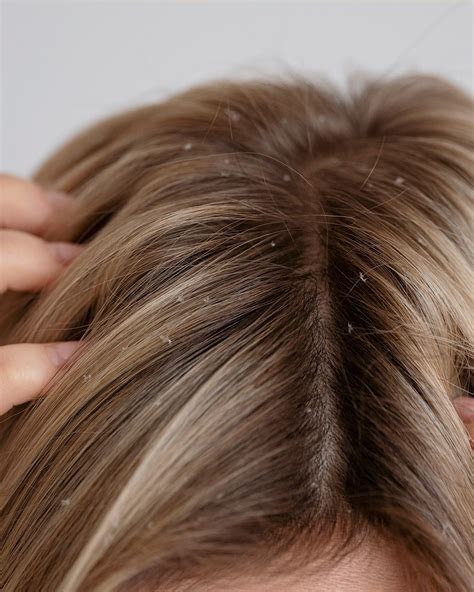 Some Of The Most Common Beliefs About Dandruff Hair Care Are Just Myths