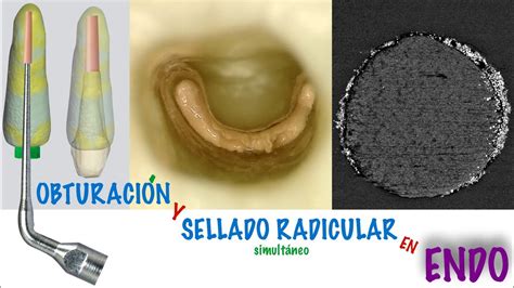 Curso Obturaci N Apical Y Sellado Radicular Simult Neo En Endodoncia