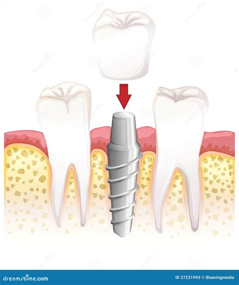 Dental Crown Procedure Stock Photos - Image: 27231993