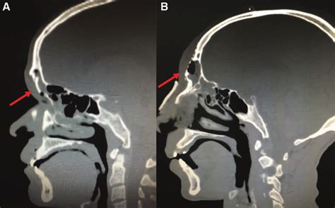 A 28 Year Old Man With Comminuted Fracture Anterior Wall Frontal Sinus