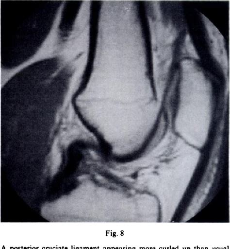 Figure From Magnetic Resonance Imaging Of Meniscal And Cruciate