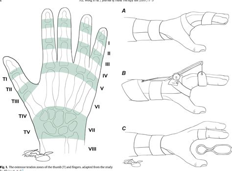 Figure 1 From The Optimal Orthosis And Motion Protocol For Extensor