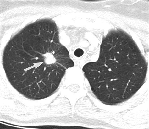 Sonographically Guided Biopsy Of Supraclavicular Lymph Nodes A Simple Alternative To Lung