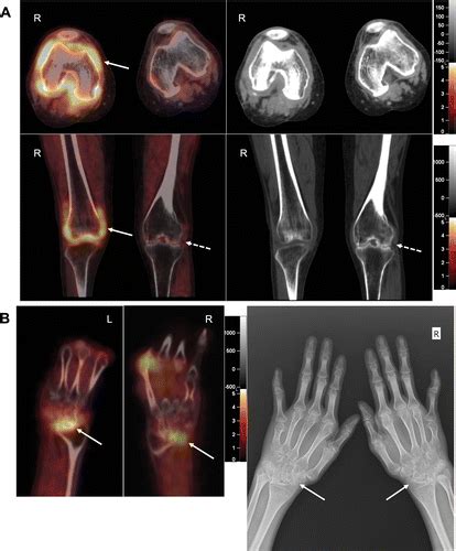 Ga Fapi Pet Ct For Rheumatoid Arthritis A Prospective Study Radiology