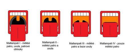 Difficult intubation - WikiLectures