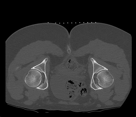 Bilateral Pudendal Nerve Block