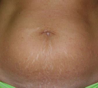 Stretch Marks Removal Bakersfield CA Botox Laser And Skin Care In