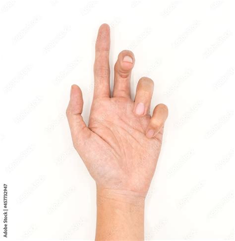 Ulnar Claw Hand Of Asian Young Man Also Known As Spinsters Claw