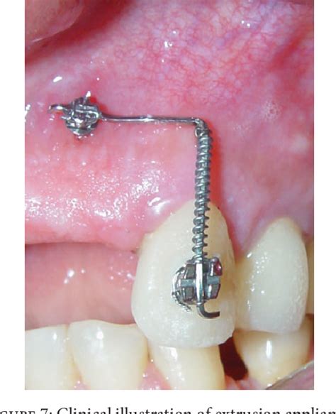 Figure 11 From Dental Extrusion With Orthodontic Miniscrew Anchorage A Case Report Describing A