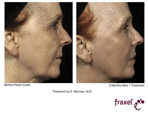 fraxel  laser wwwmdcosmedicalcomau