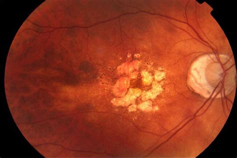 Degeneración macular asociada a la edad DMAE En Ojopedia