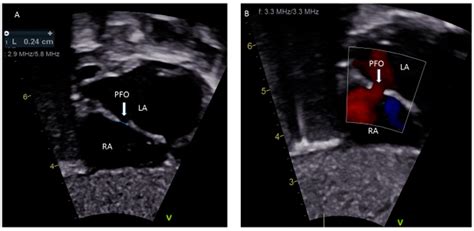 Medical Sciences Free Full Text Patent Foramen Ovale In Fetal Life