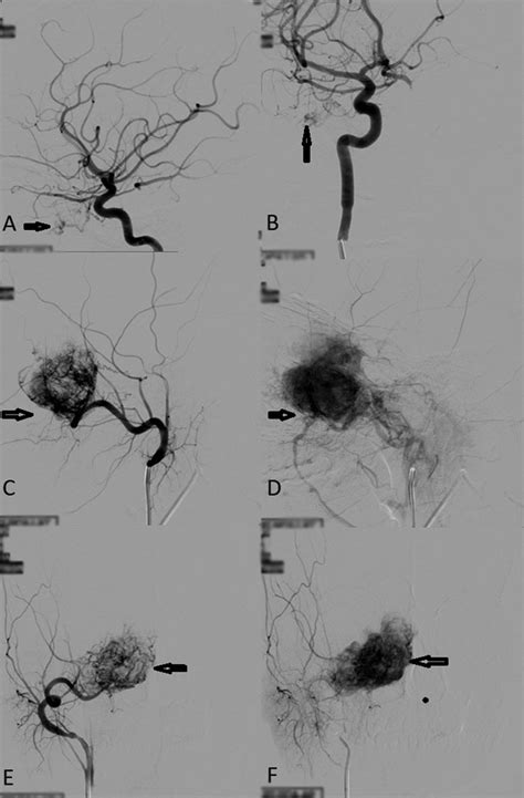 Digital Subtraction Angiography Dsa Of Right Internal Carotid Artery Download Scientific