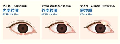 「ものもらい」の原因・症状・対処法 ロート製薬 商品情報サイト