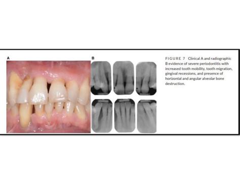 Diagnosis Of Periodontal Diseases Pdf