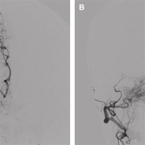 Right External A And Internal B Carotid Angiography Download Scientific Diagram