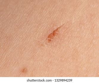 Wound On Human Skin Background Macro Stock Photo 1329894239 Shutterstock