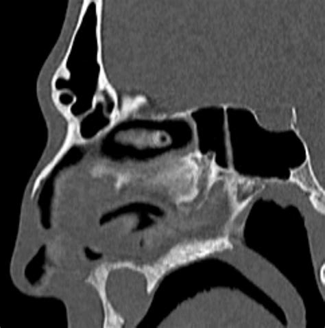 Nasopalatine Duct Cyst NPDC Image Radiopaedia Org