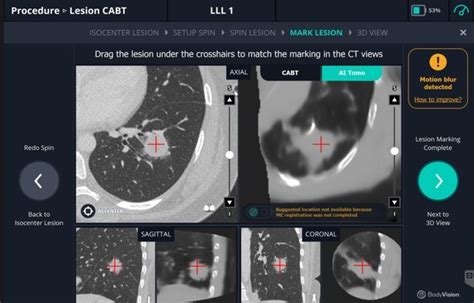 Body Vision Medicals Latest Lungvision® Software Enhances Ai