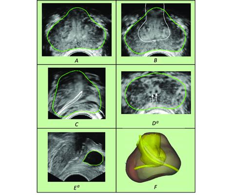 Ultrasound Image Segmentation Images From A Contrast Enhanced