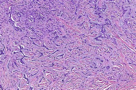 Morpheaform Basal Cell Carcinoma