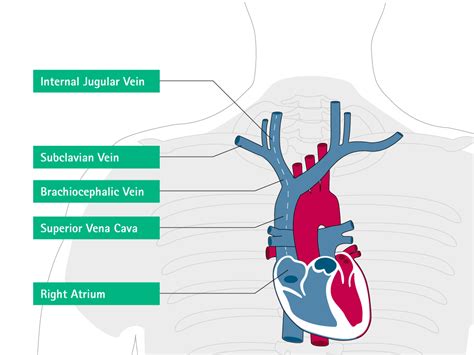 Misplacement And Malposition Of Central Venous Catheters