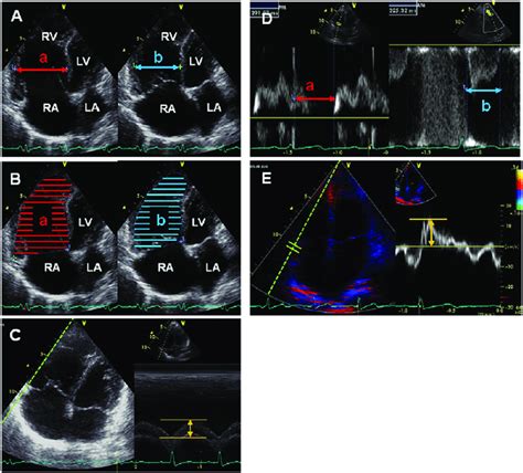 Representative Images Of Echocardiographic Assessment Of Right