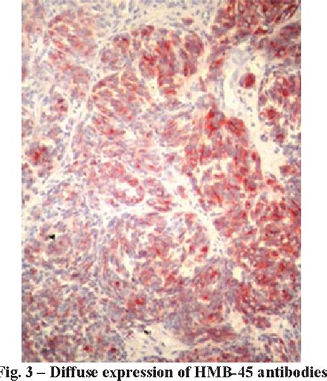 Figure 3 From Metastatic Malignant Ovarian Melanoma A Case Report