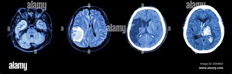 Ct infarto cerebral fotografías e imágenes de alta resolución Página