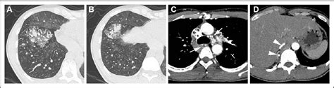 Figure 1 From Endovascular Repair Of Diffuse Pulmonary Arteriovenous