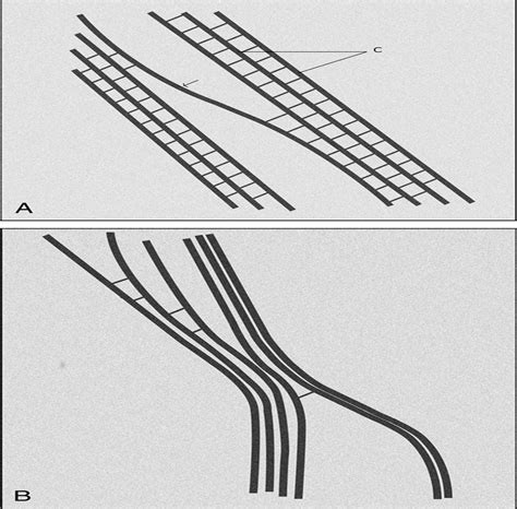 PATHOGENESIS OF RHEGMATOGENOUS RETINAL DETACHMENT: Predispos... : RETINA