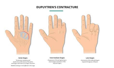 Dupuytrens Contracture Florida Oncology Tavares