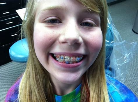 Cute Braces Colors For Winter Kristal Foote