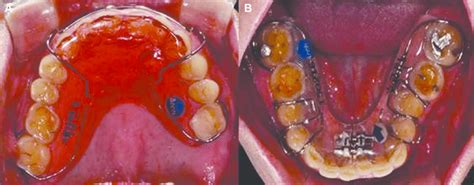 Orthodontic Treatment A Bite Plate On Maxilla B Schwarts On Download Scientific Diagram