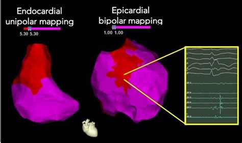 Right Ventricular Outflow Tract Endocardial Unipolar Substrate Mapping